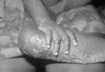 Primeiro caso suspeito de varíola dos macacos é notificado pelo governo de Pernambuco